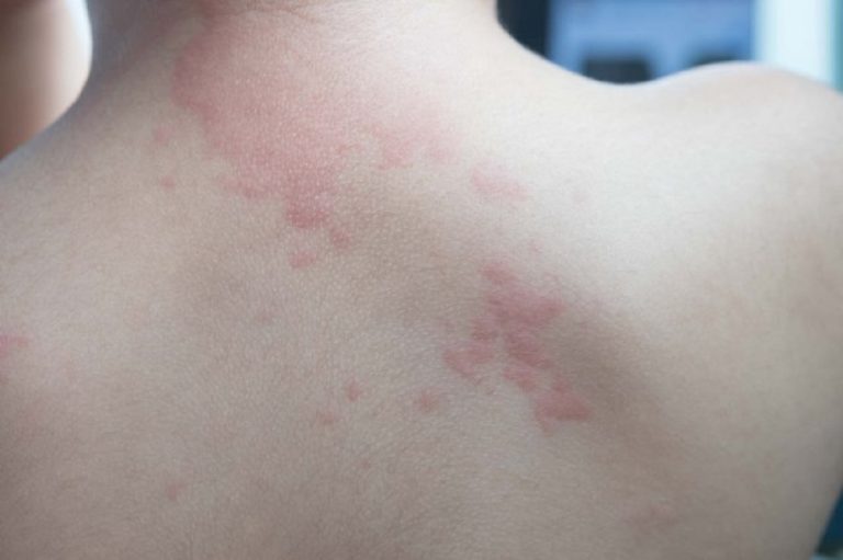 Plaques Rouges Sur Le Torse Les causes possibles de l'apparition de plaques rouges sur la peau