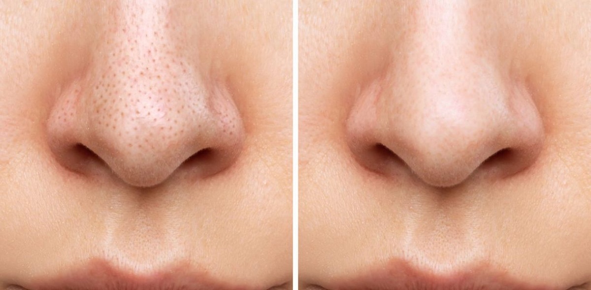 diminuer les pores de la peau
