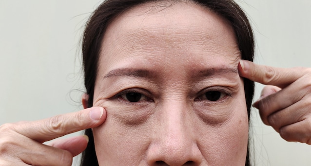 Poches oculaires liées à la vieillesse