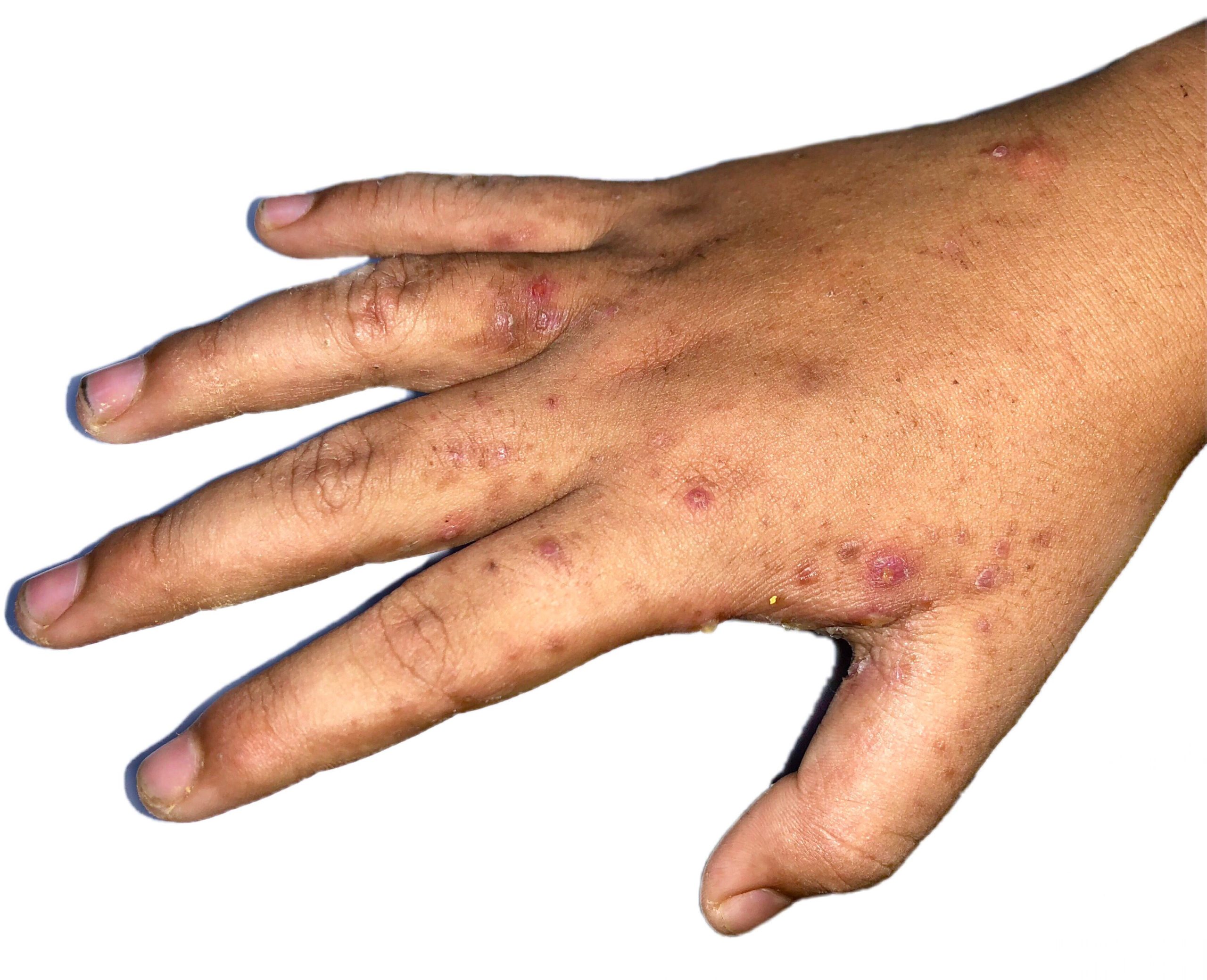 mano ferite da scabbia