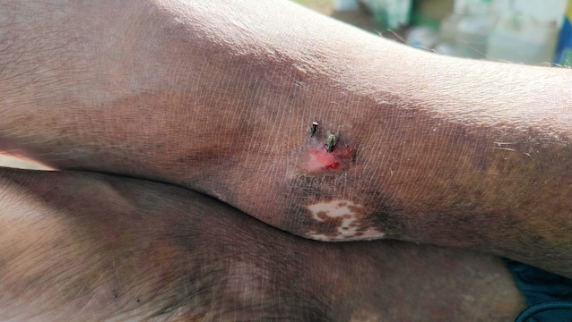 blessures infectées