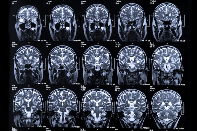 scan de résonance magnétique